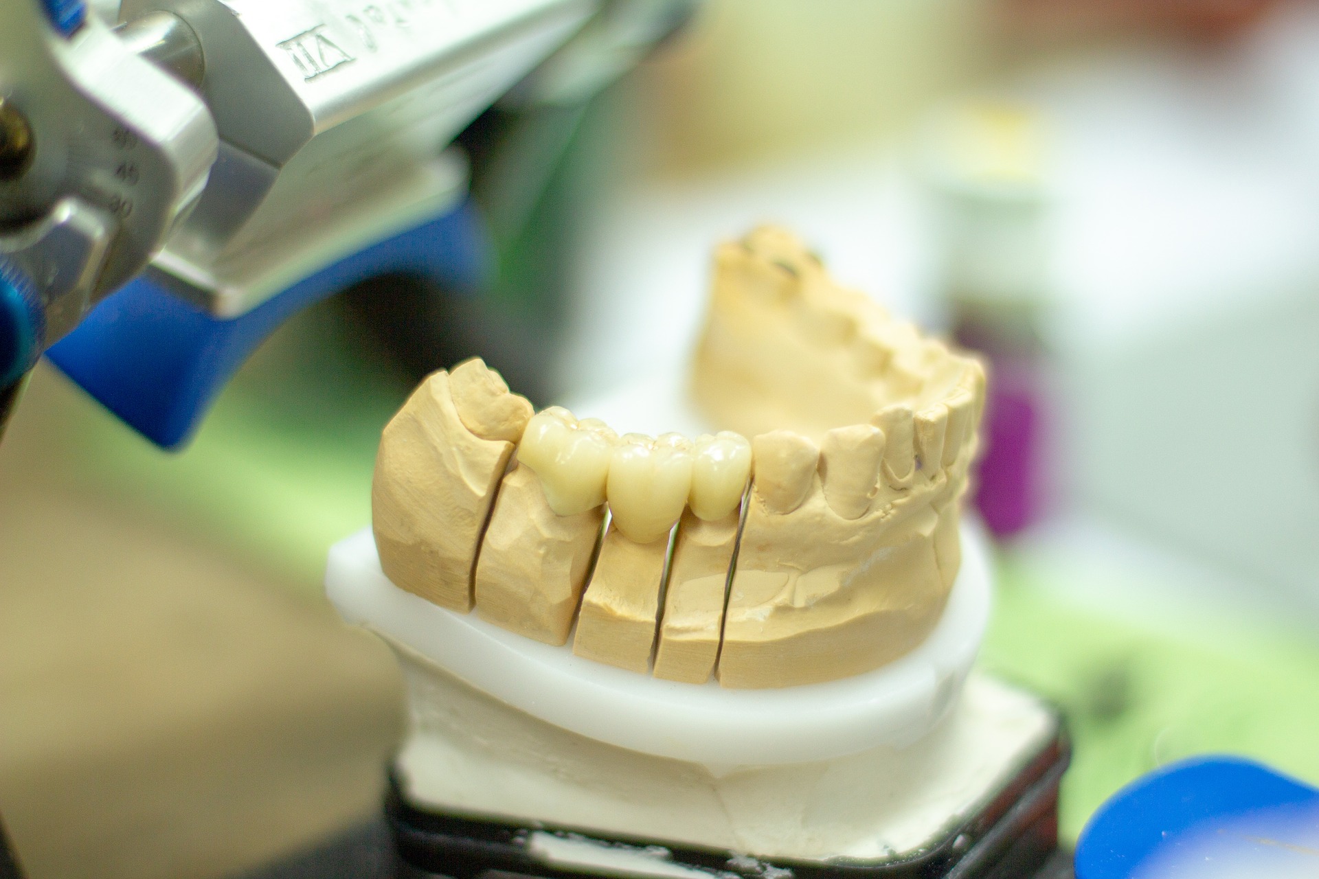 Erfahrung implantat zahn Zahnimplantate