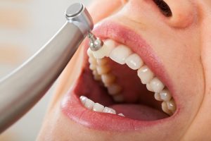 Eine regelmäßige Prophylaxe und eine gründliche Zahnreinigung für langfristige Zahngesundheit.